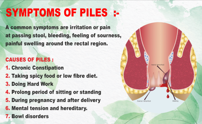 Symptoms of Piles hemorrhoids